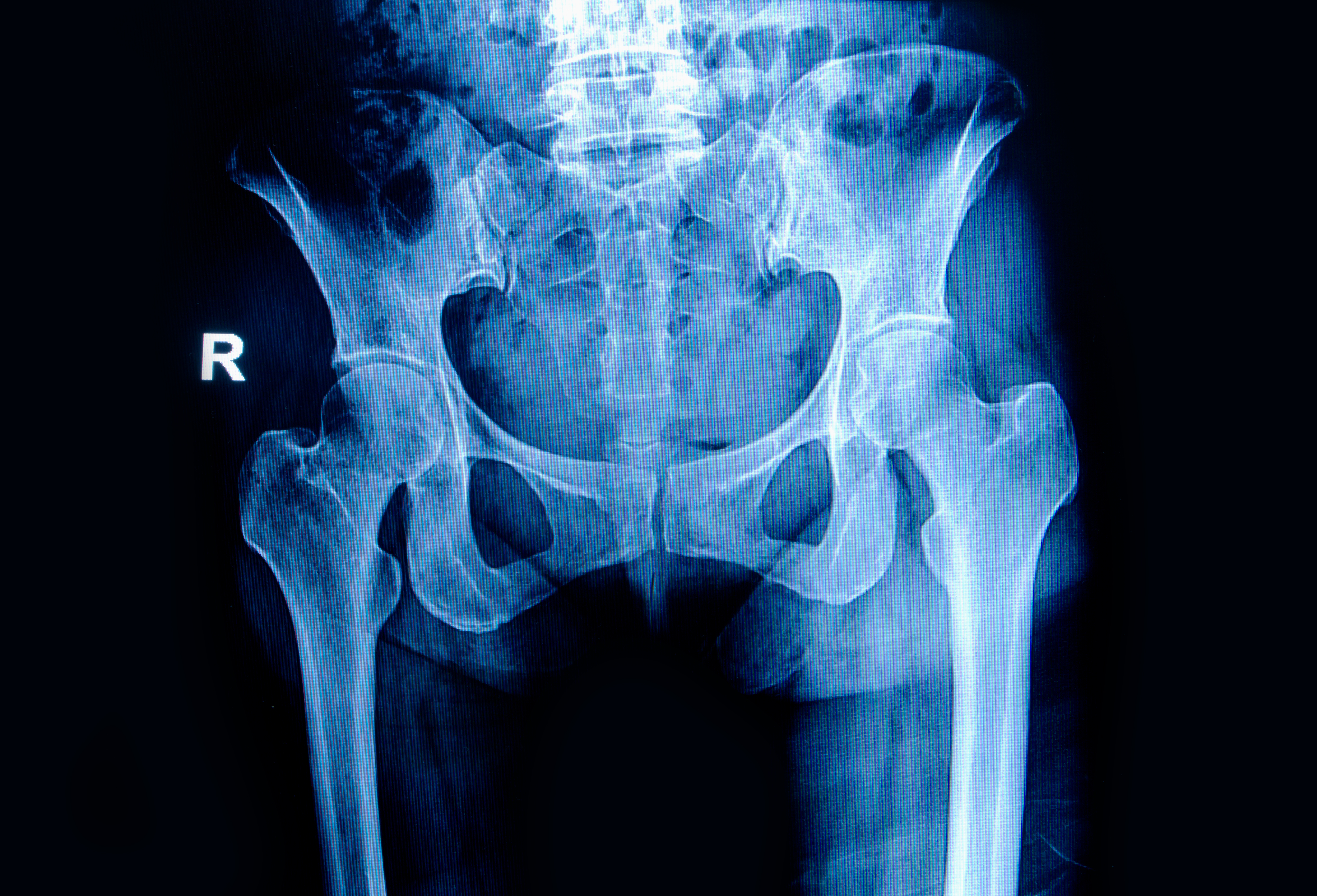 X-rayphoto of a hip