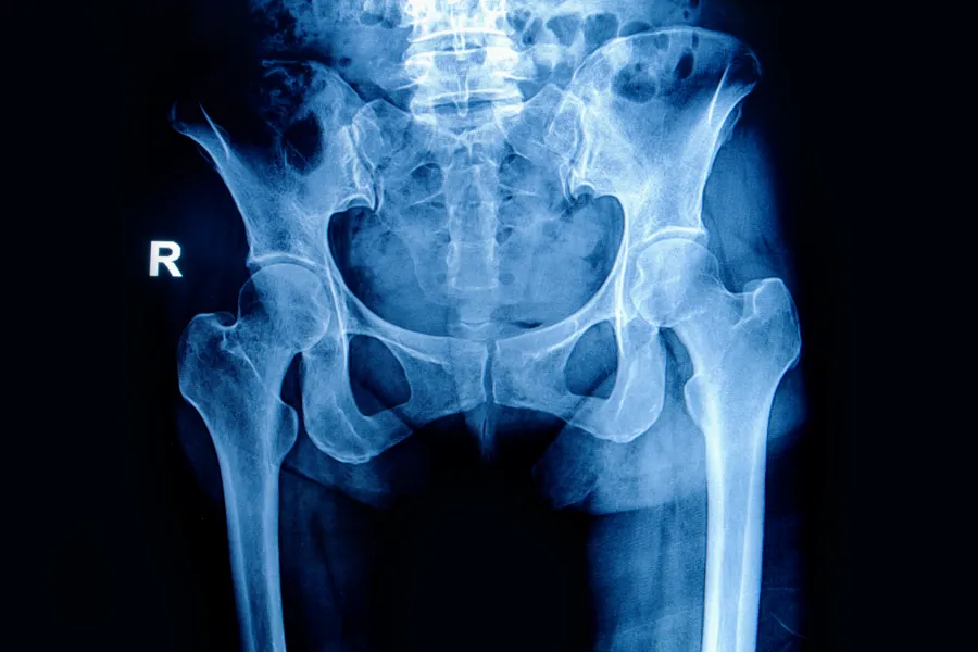 X-rayphoto of a hip