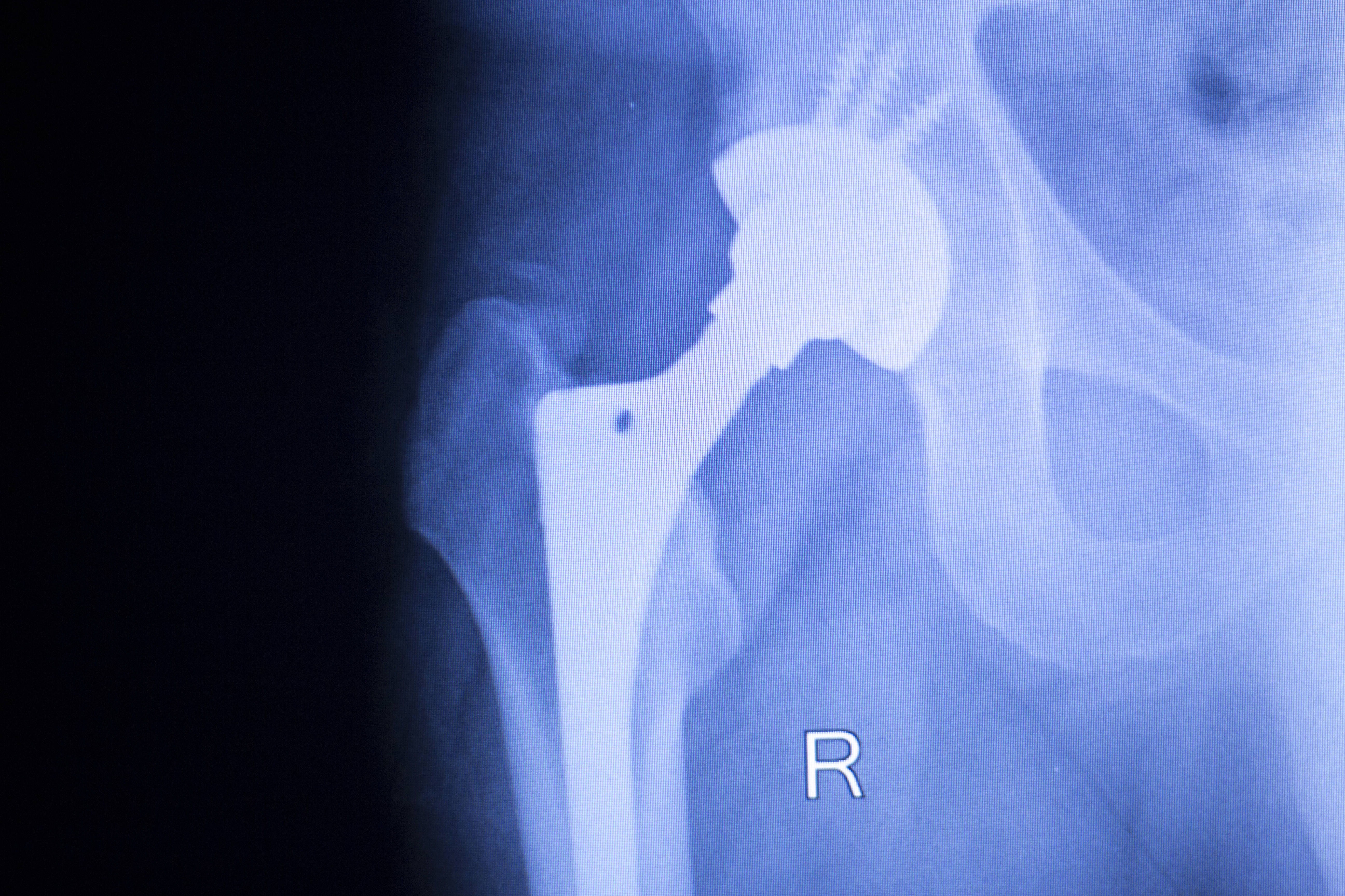 X-ray of a hip