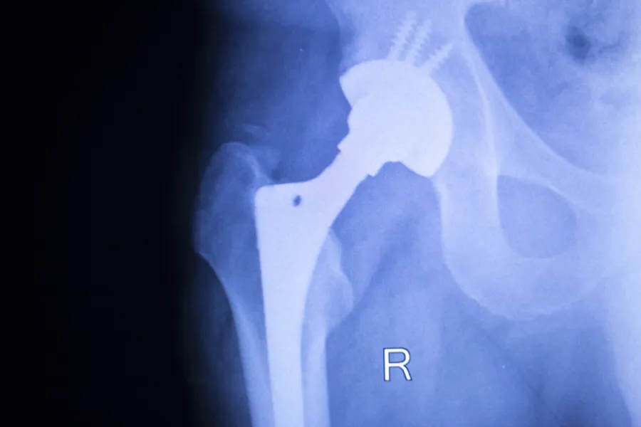 X-ray of a hip